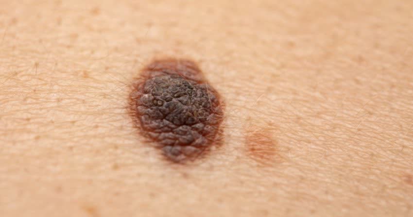 Melanoma Melanoma metastatico.004