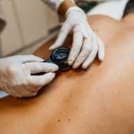 Melanoma: bastano poche scottature per aumentare il rischio. Gli esperti avvertono: “Attenzione già da giovani”