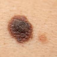 Melanoma: l’immunoncologia diventa di precisione grazie a nuovi biomarcatori