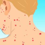 Firenze - Bimba di 19 mesi intubata a causa del morbillo: l’appello: “Vaccinate i piccoli”